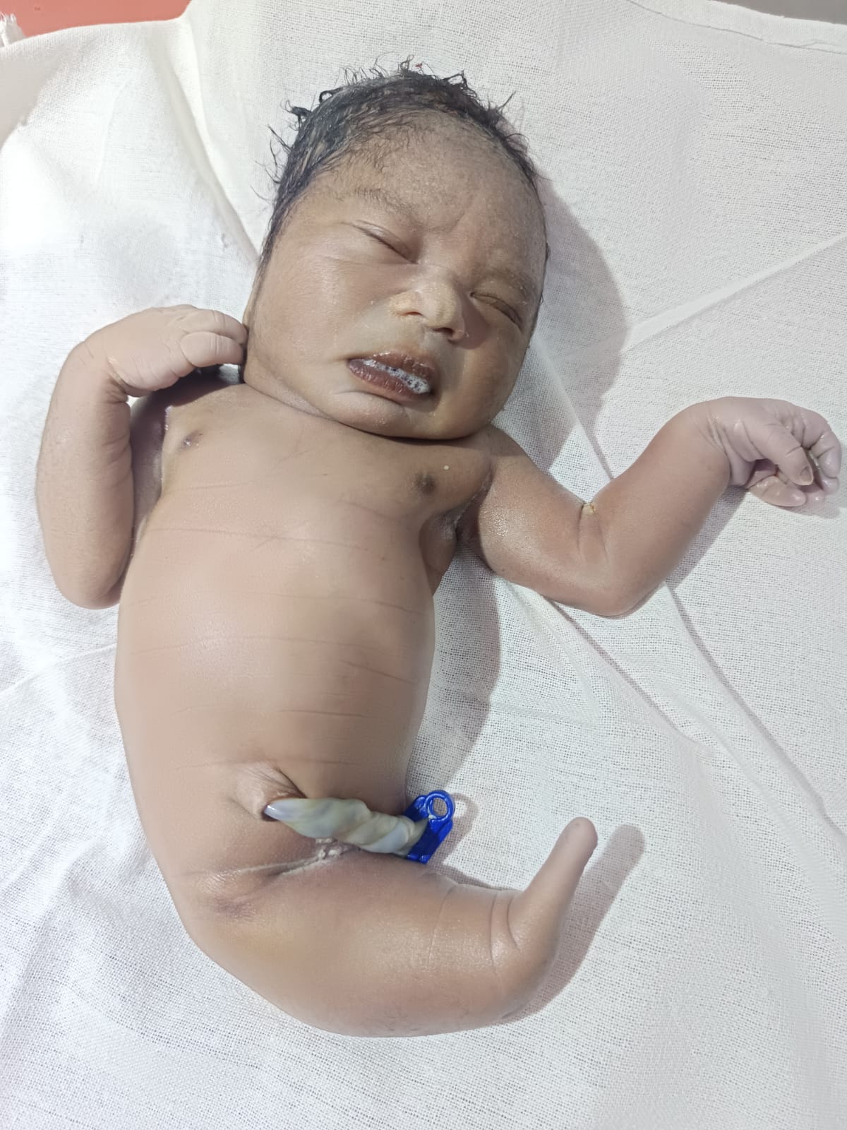 Saraikela: सरायकेला में जन्मा दुर्लभ पूंछ वाला बच्चा, चिकित्सा जगत में हलचल