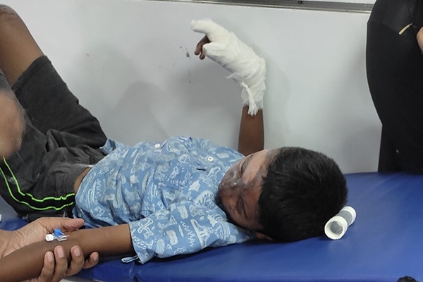 Jamshedpur : पटाखा के विस्फोट से 11 वर्षीय पीयूष गंभीर रूप से झुलसा